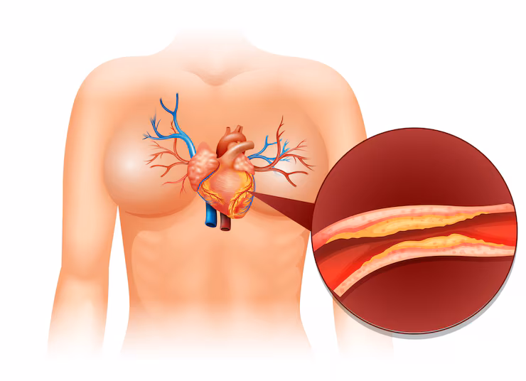 Coronary Angioplasty